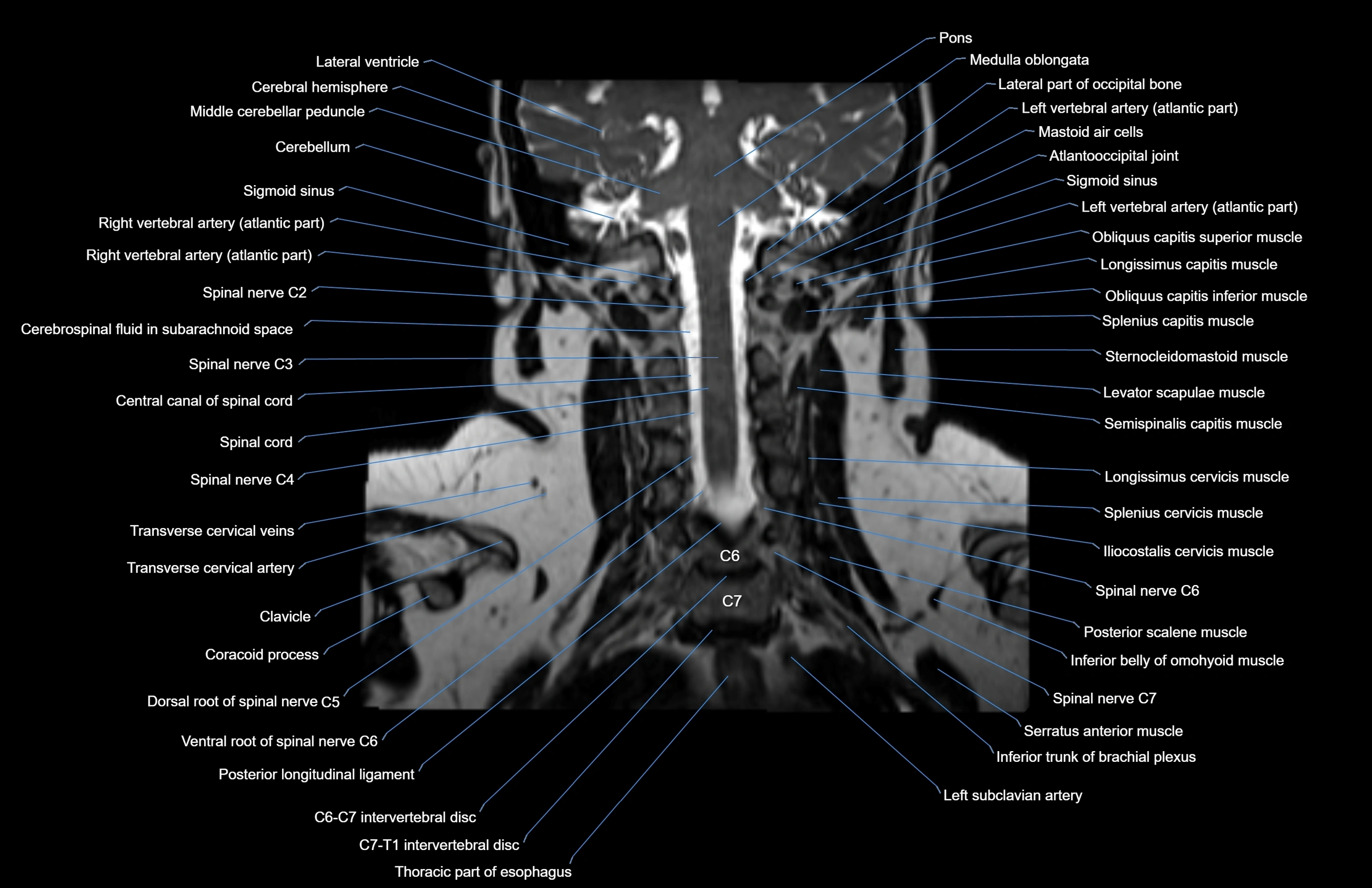 Neck coronal cross sectional MRI anatomy 3T MRI  image-img-00001-00024.webp